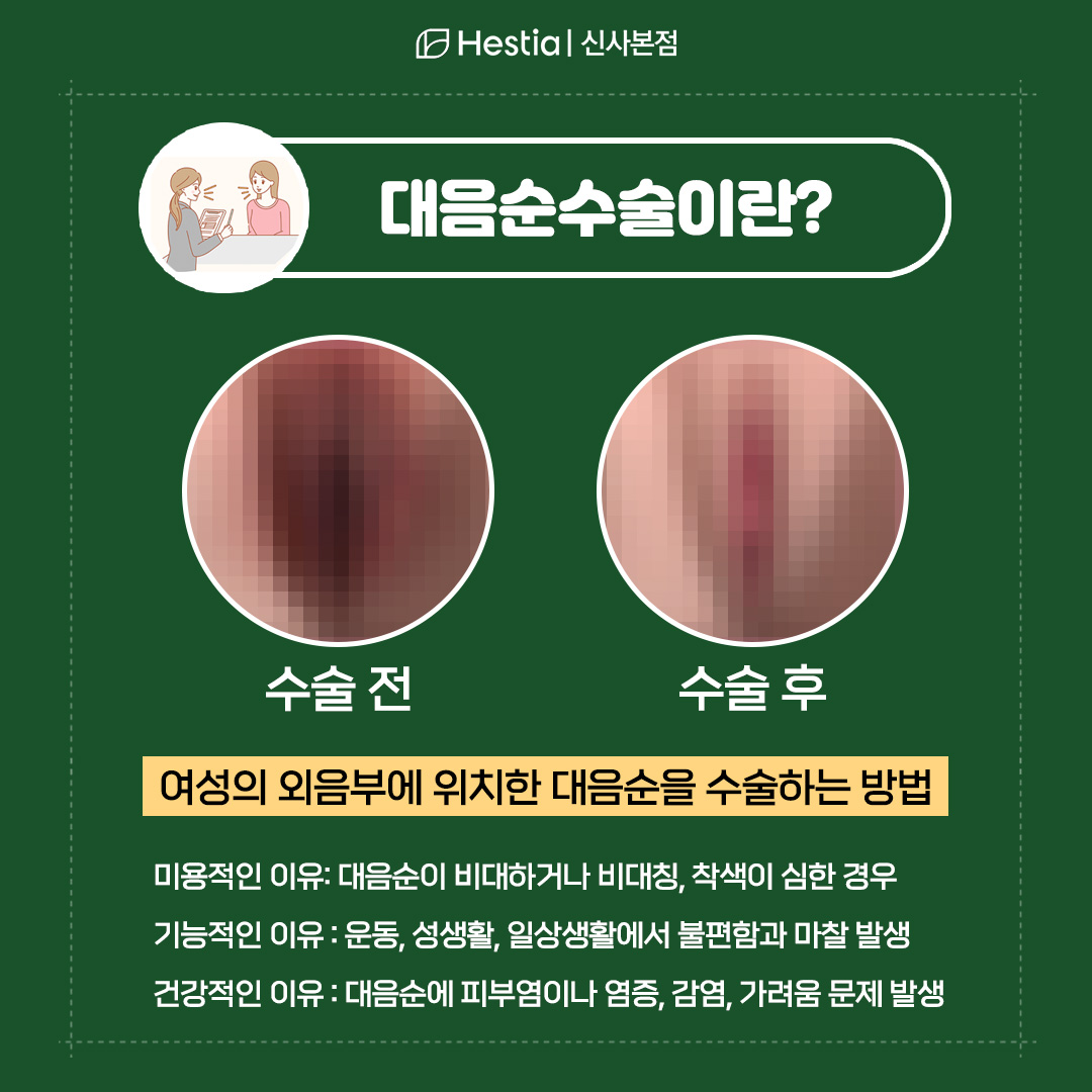 대음순성형이란?