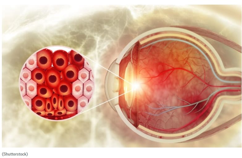 코로나19 백신 접종 후 시력 장애...의사들 위험 경고 Vision Impairments in Patients After COVID-19 Vaccination&#44; Doctors Caution Possible Risks
