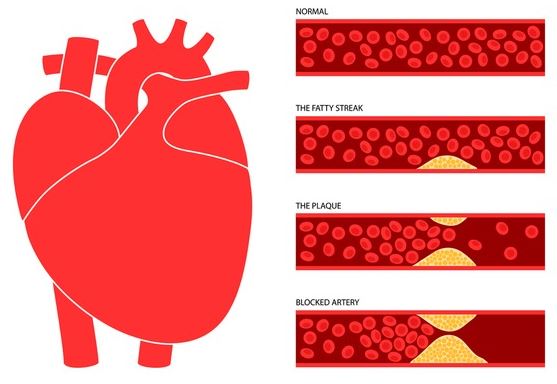 심혈관계-질환