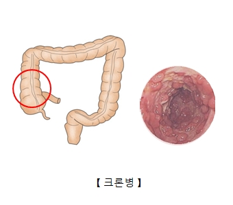 크론병-증상-완치-음식