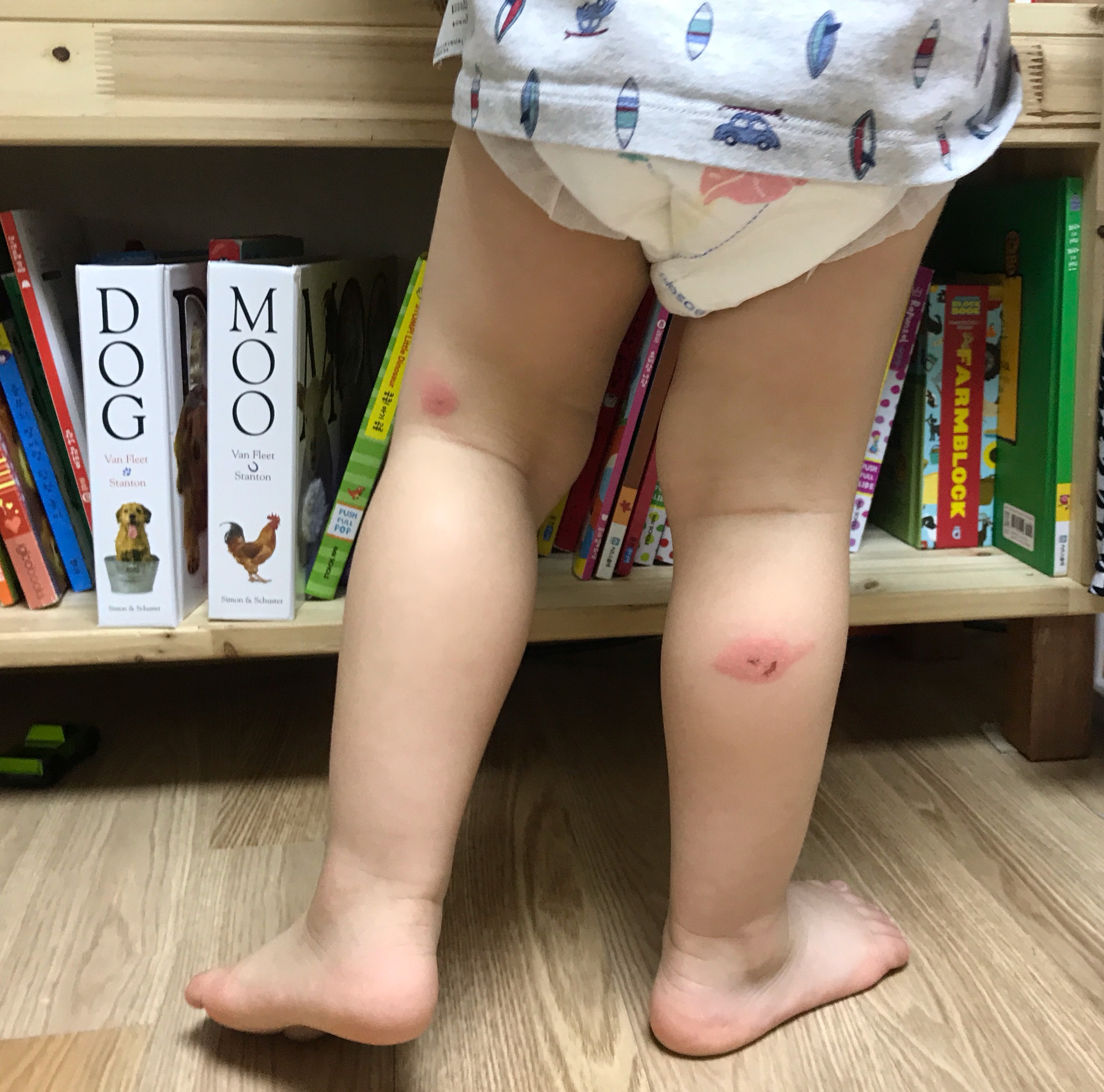 아기 모기물렸을때 아기 농가진으로 갈 수 있어요. 주의해야 할 점!(병원방문) 7