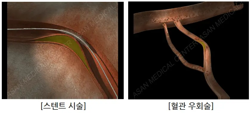 동맥경화증 치료 방법 (출처 : 서울아산병원 건강정보)