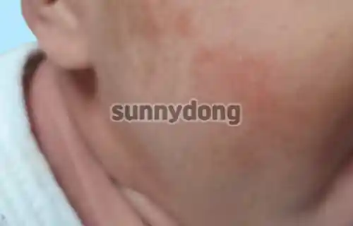 아기 건선 이미지
