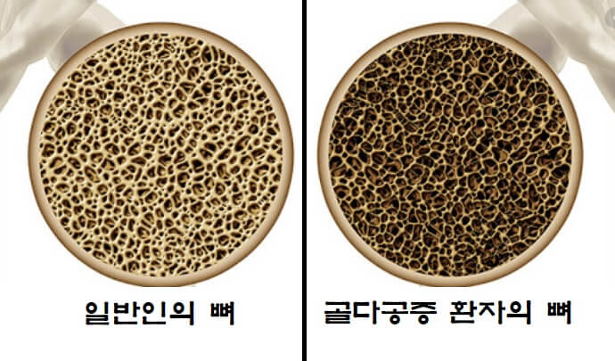 일반인과-골다공증-환자의-뼈-내부