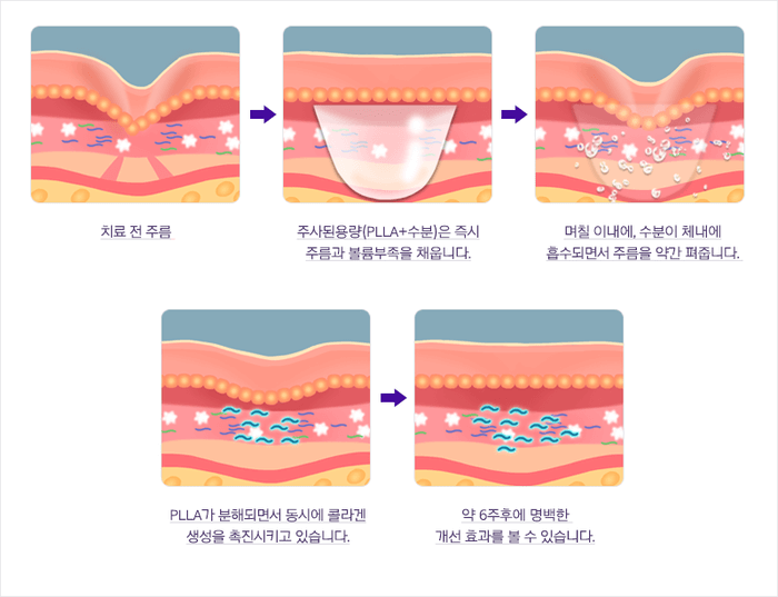 콜라겐 주사 효과부터 비용