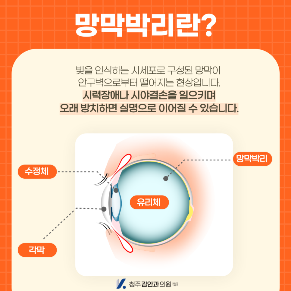  망막박리 고도근시가 원인, 치료는?