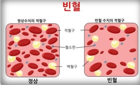 혈액검사 단백질 부족