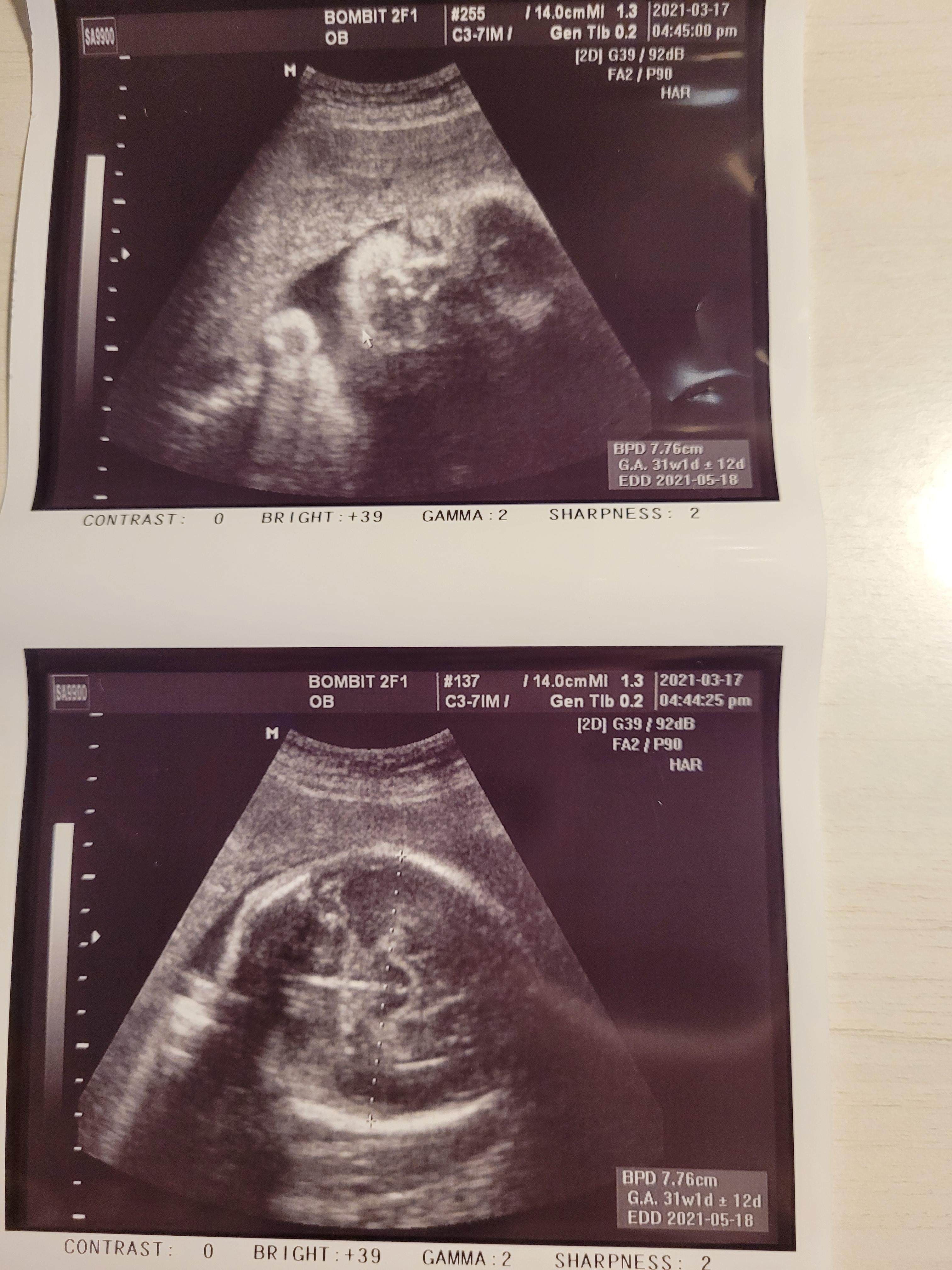 (임신 29주) 자궁수축증상 및 백일해 주사 + 아기체중 5