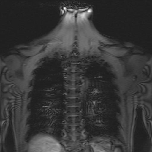  t-spine coronal scan