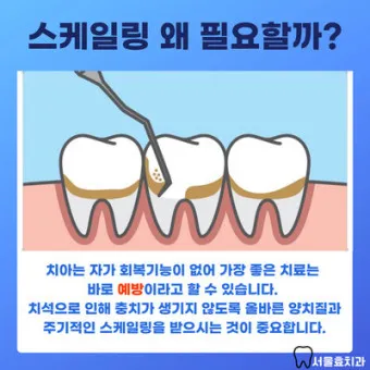 스케일링 후 양치 통증 음식_2