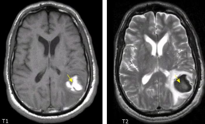 초기 아급성기 ICH의 T1WI &amp; T2WI 사진
출처 : https://case.edu/med/neurology/NR/SubacutelateICH.htm