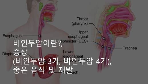 비인두암 이란, 증상(3기, 4기), 좋은 음식 및 재발