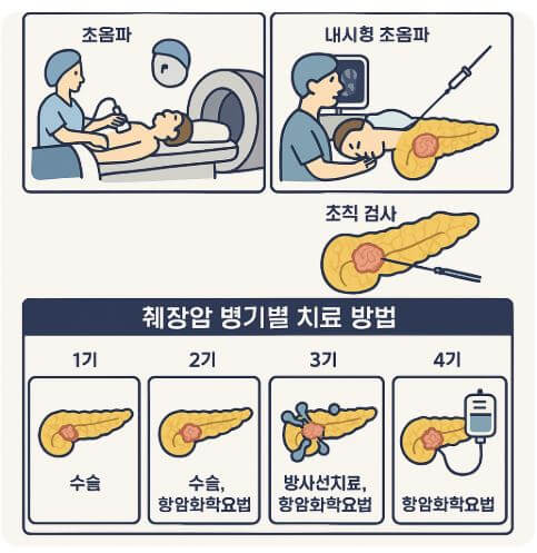 췌장암 검사 방법 병기별 치료 방법