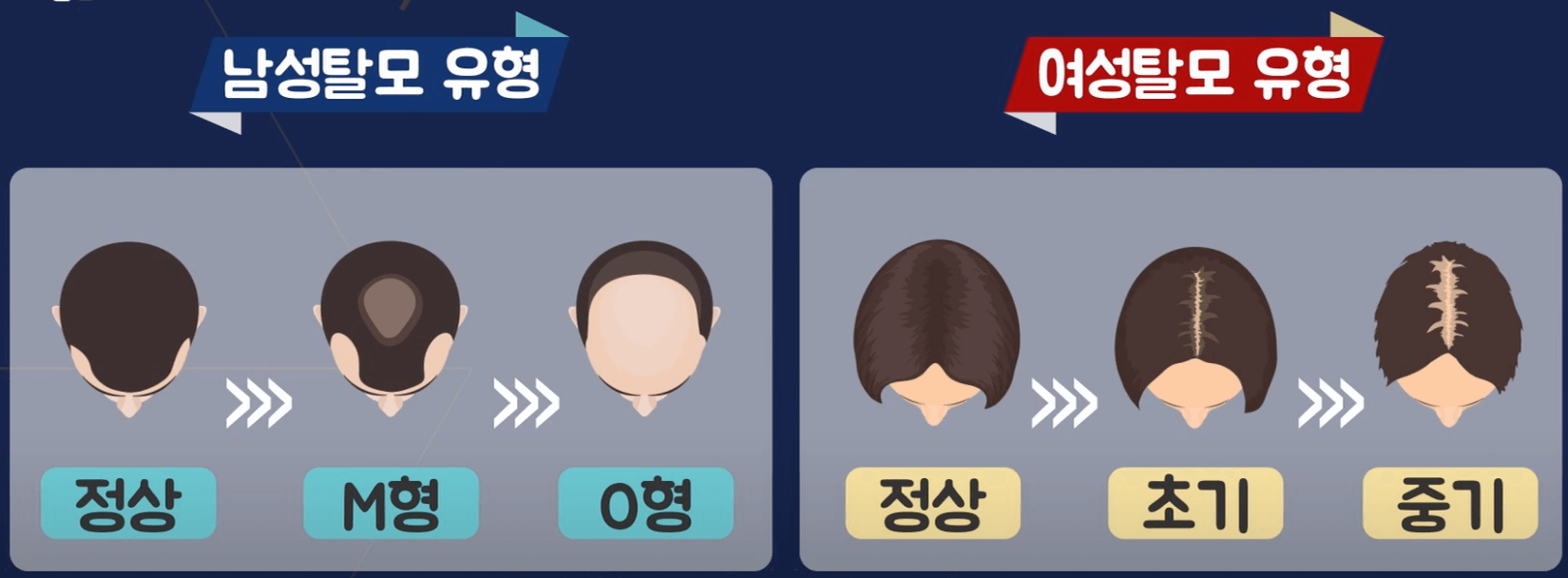 남성탈모유형-여성탈모유형