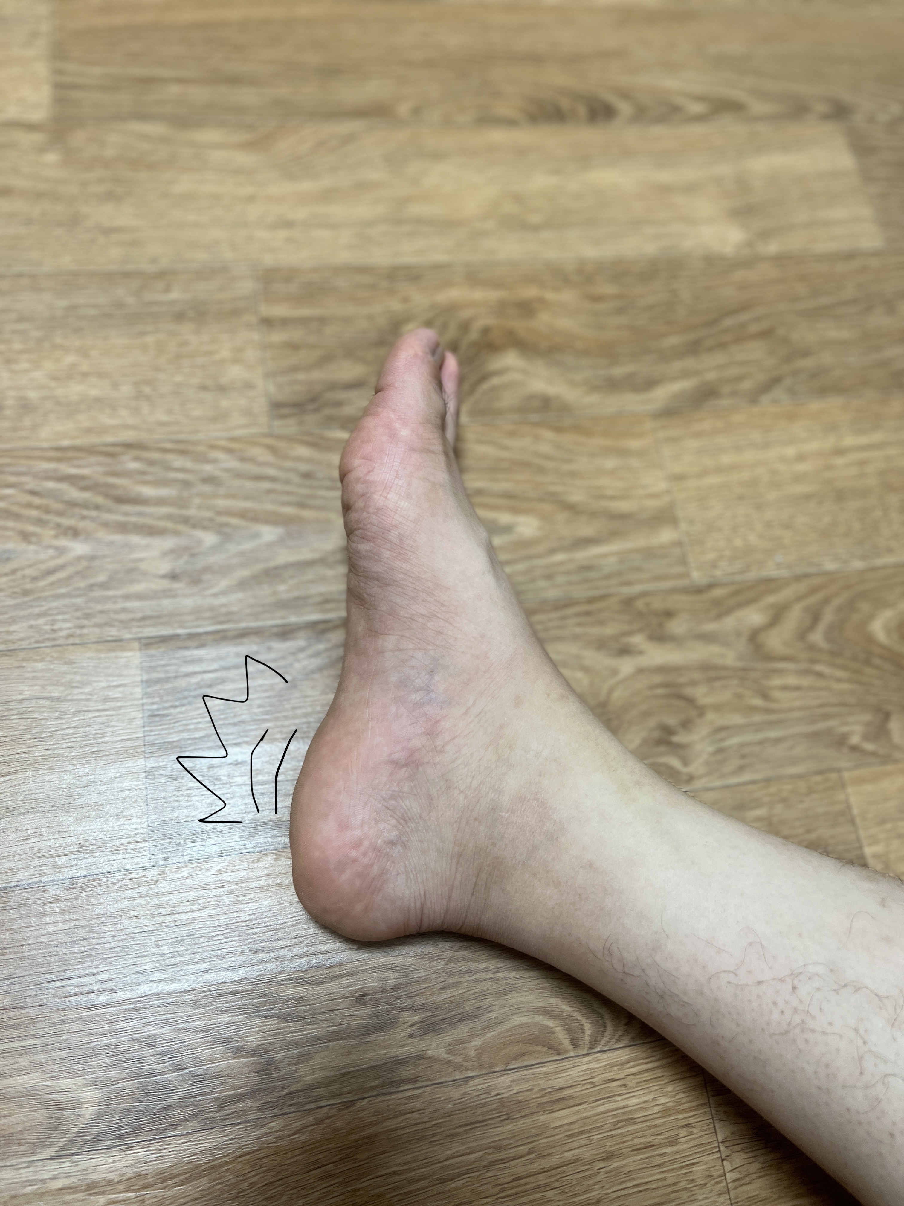 사람 발에 통증 표시