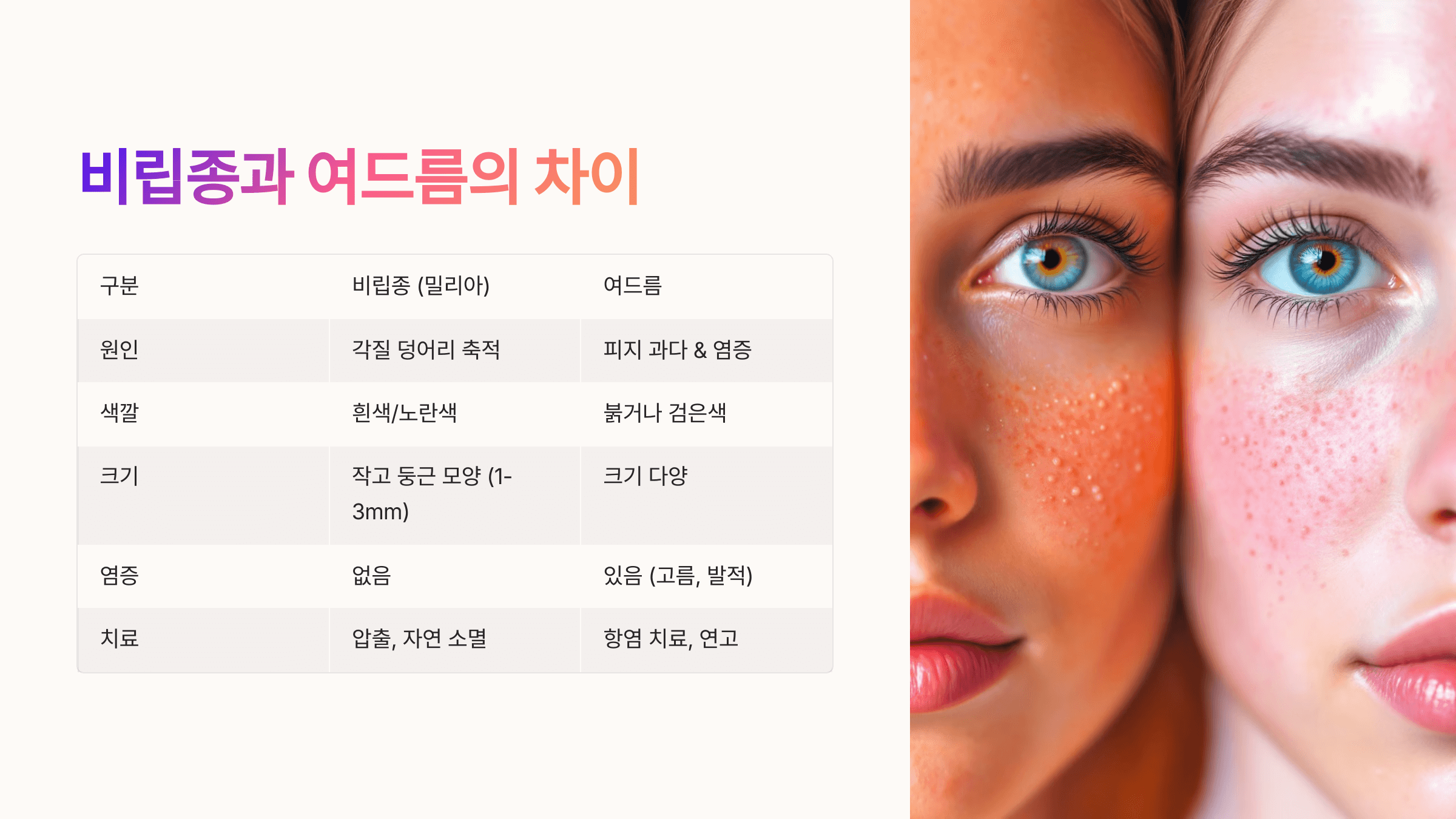 비립종과 관련된 사진입니다.