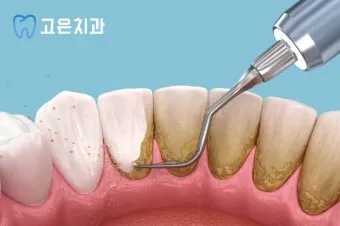 스케일링 후 양치 통증 음식_25