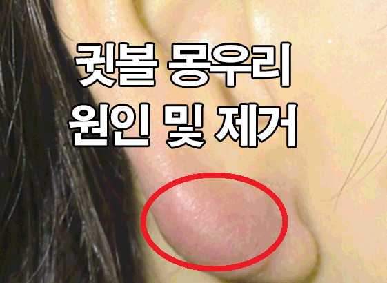  귓볼 몽우리 원인 및 제거 : 피지낭종, 표피낭종