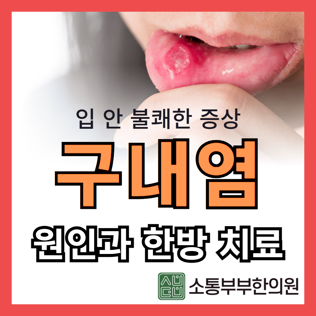  구내염 원인과 증상, 한방 치료법