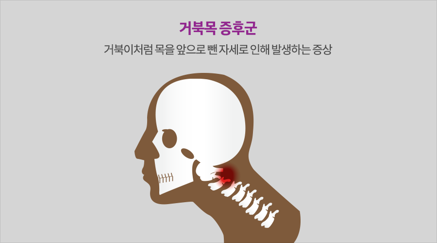 거북목 증후군