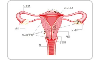 배란통 증상 및 시기 원인_10