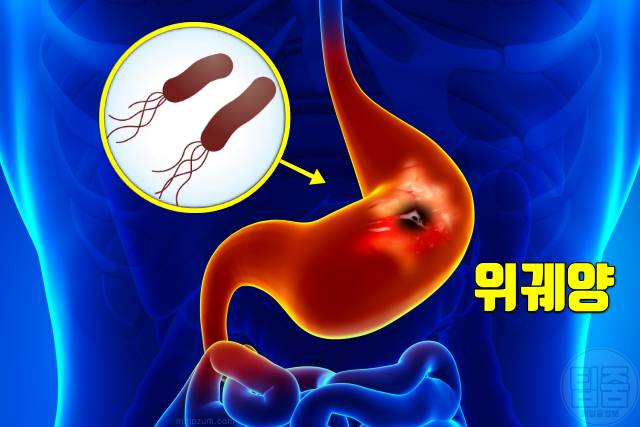 배에 가스가 차는 이유 배에 가스차서 아플때 위궤양 십이지장궤양