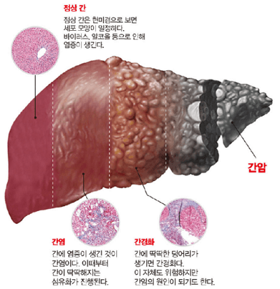 건강한-간-간염-간경화-간암