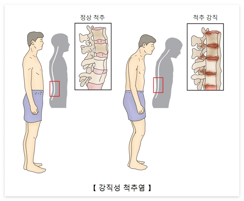 강직성-척수염