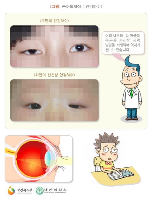  눈꺼풀처짐(안검하수) 수술로 가능하다는데?