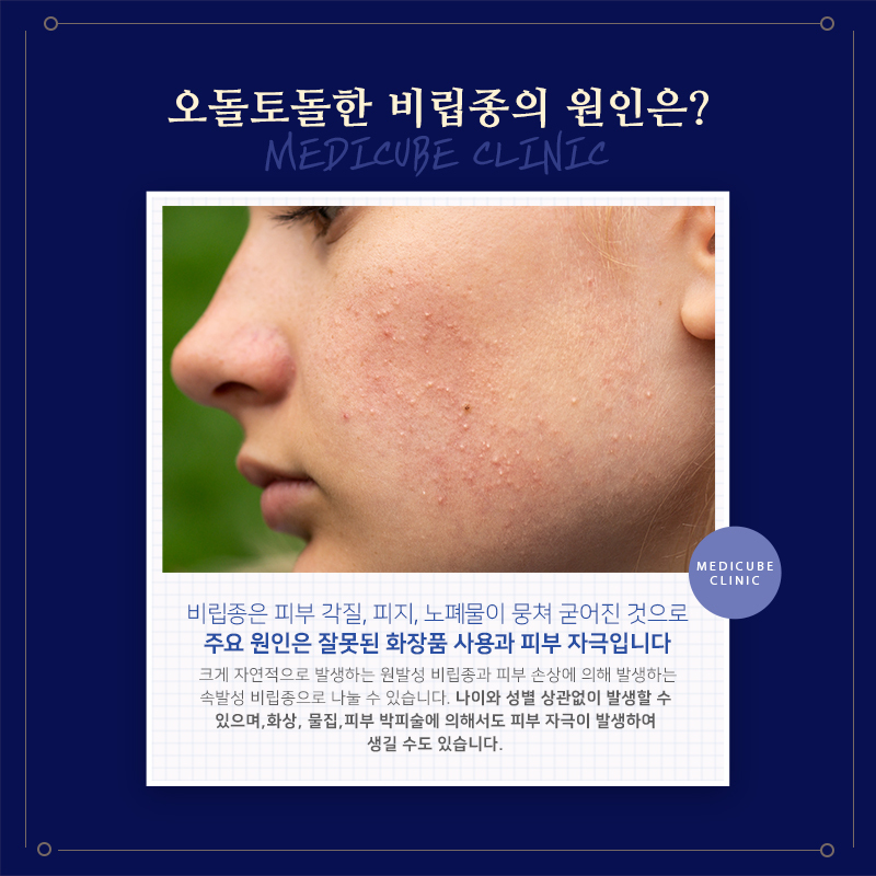  눈옆 비립종 말끔하게 없애는 방법 (인계동피부과)