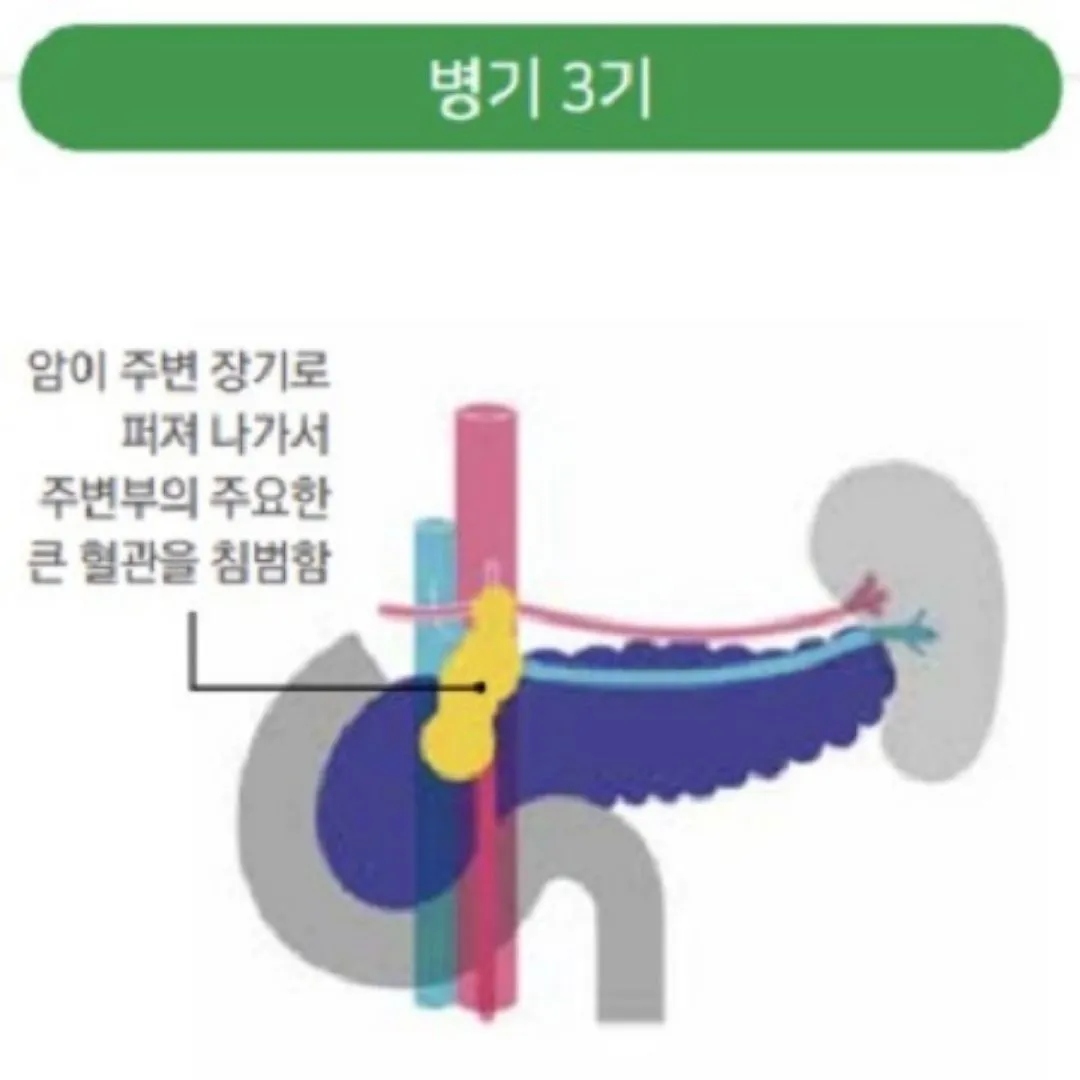 췌장암 초기증상 및 췌장암 원인