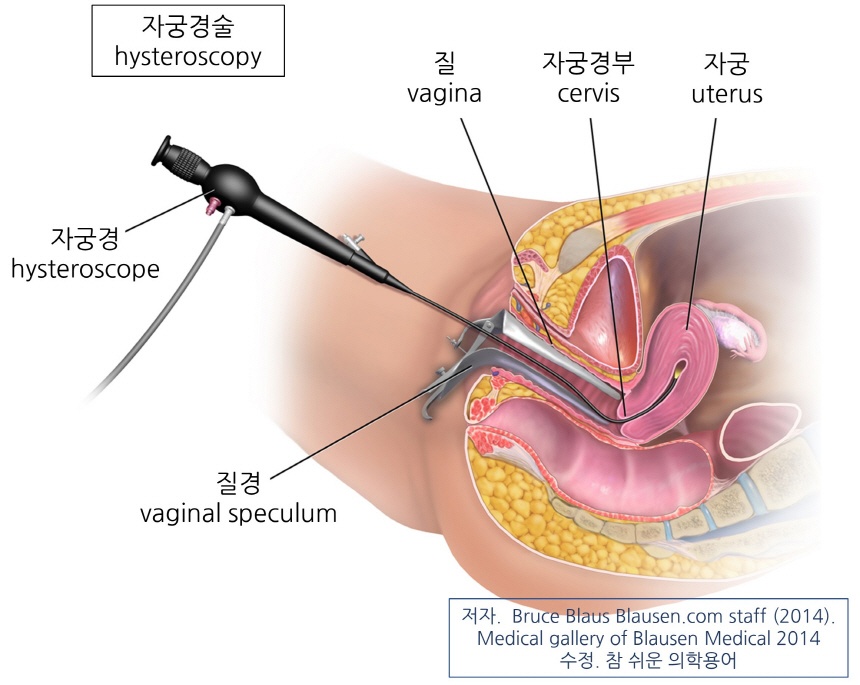 의학용어 hysteroscopy 자궁경 검사방법, 자궁경술 후유증