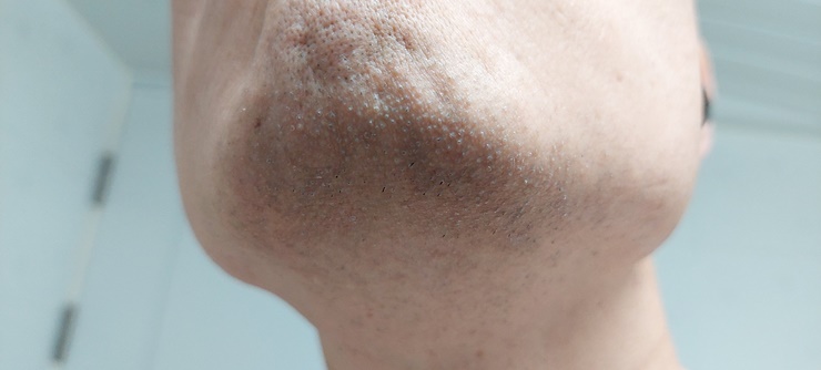 면도후 턱수염