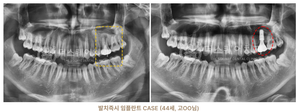 종로치과 더스퀘어치과 임플란트