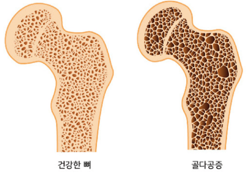 정상인-뼈와-악화되어-골다공증이-발생한-현미경-비교-사진