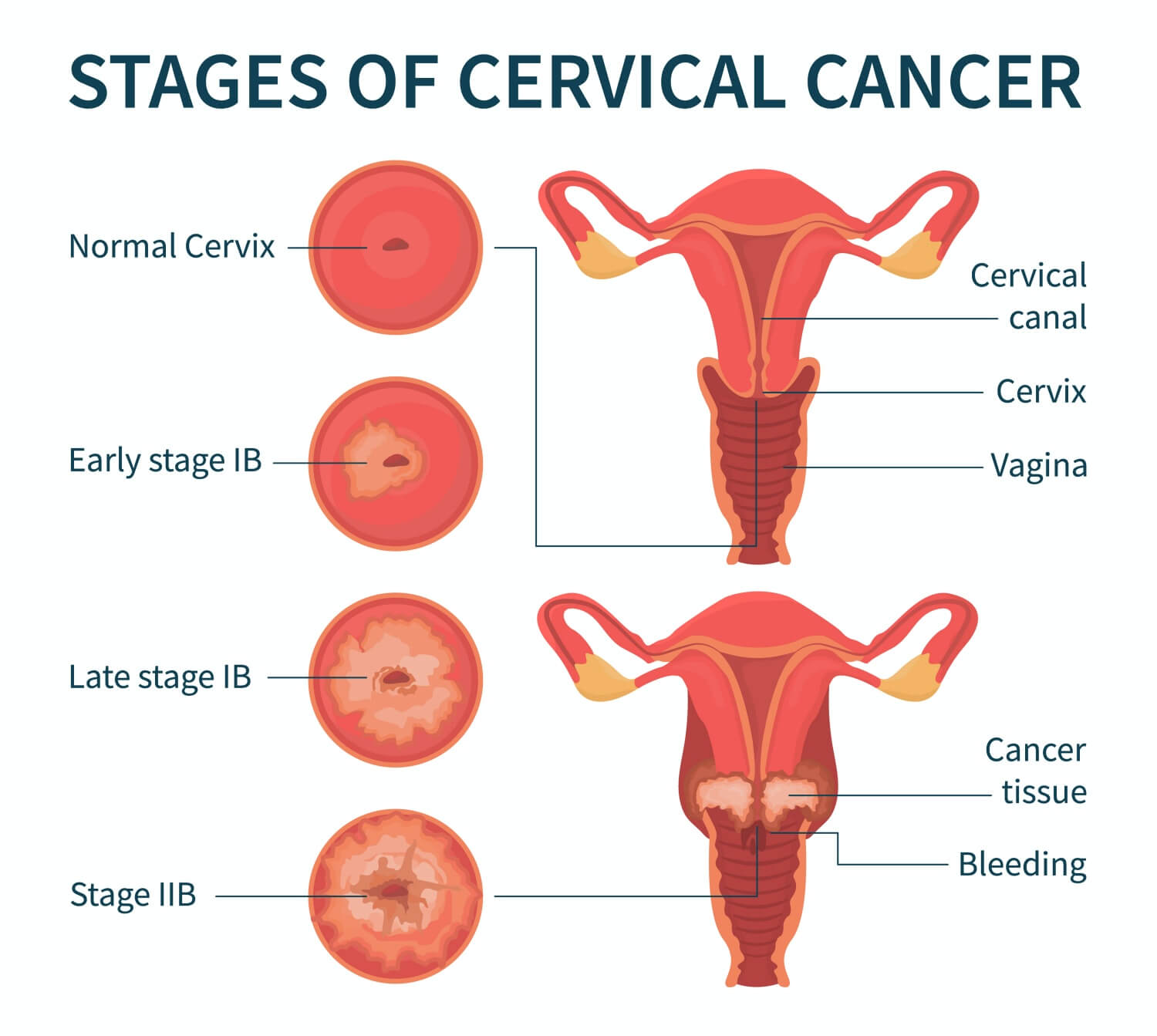 자궁경부암단계