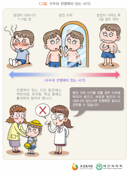  수두의 원인과 증상, 예방 및 치료법