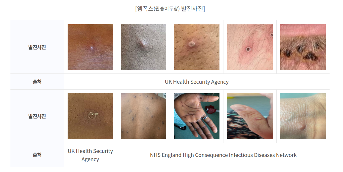 mfox-monkey pox-치료-원인-예방-백신-질문-증상