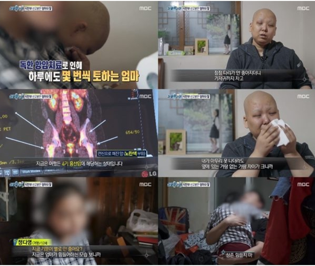  흉선암 증상 생존율