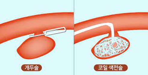 뇌동맥류-치료