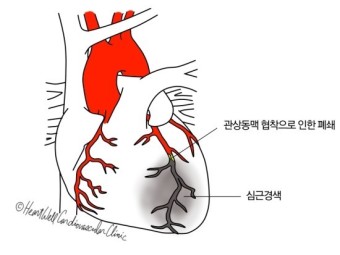 심근경색 초기증상