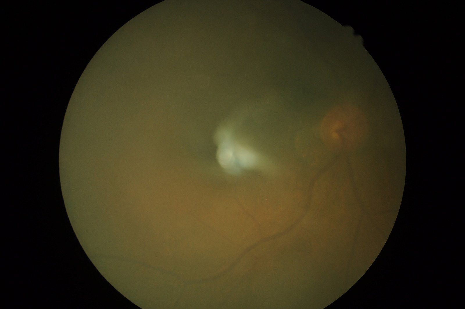 망막박리(Retinal Detachment): 증상, 원인, 치료 방법