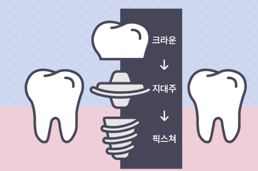 임플란트 명칭 과정