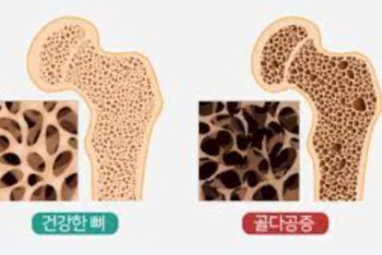 골다공증-예방