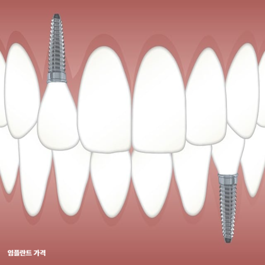 임플란트 가격