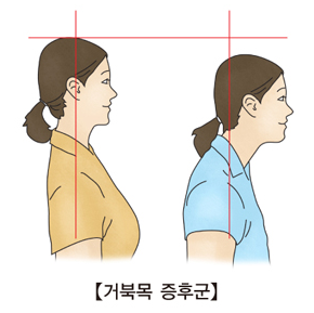 자세 교정 - 라운드 숄더(거북목) 교정법