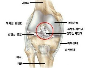 전방십자인대 파열 증상