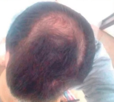 EXOSOME_HAIRLOSS