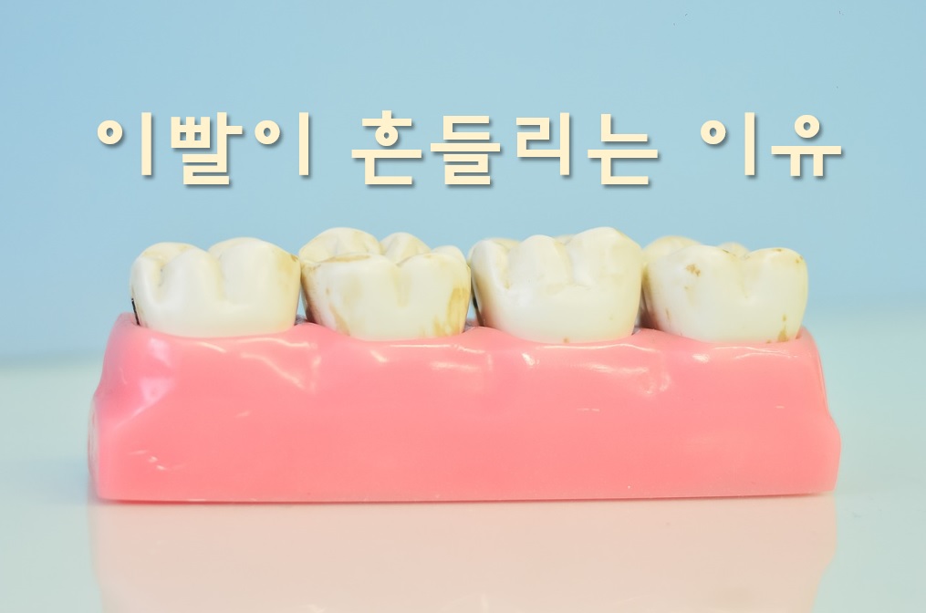  이빨이 흔들릴 때 치료방법과 흔들리는 이유