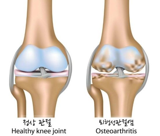 퇴행성 관절염 증상